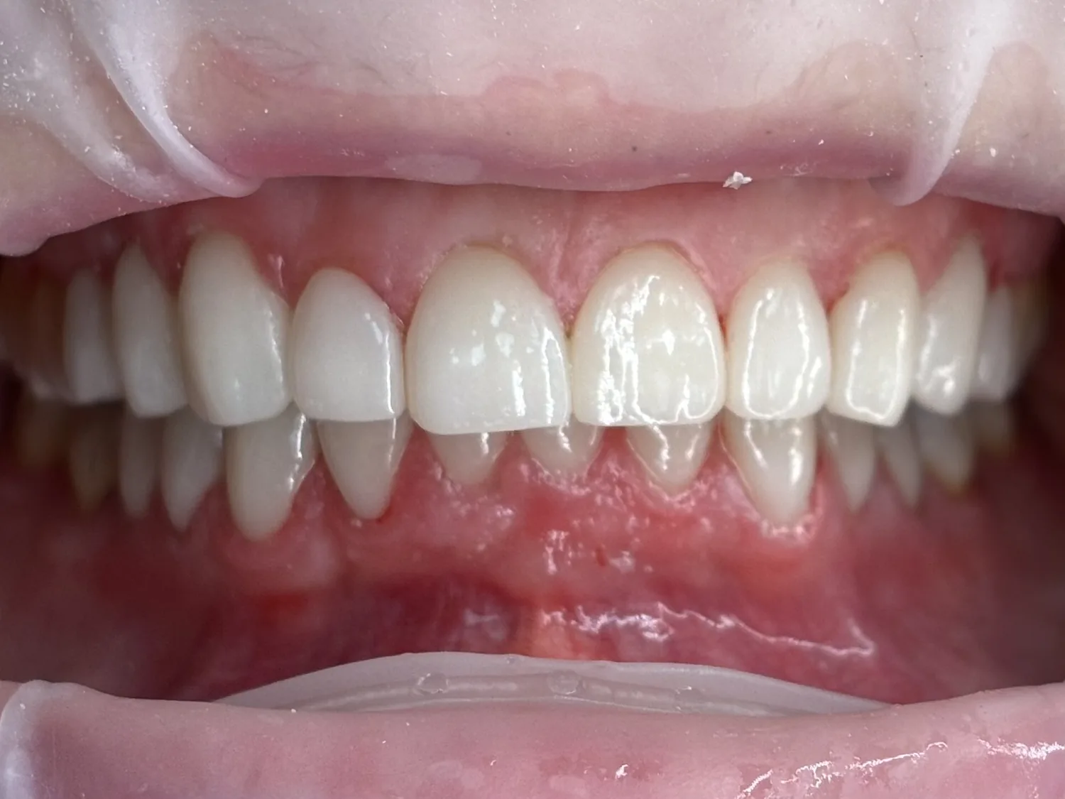 Después del blanqueamiento dental profesional: sonrisa más luminosa — Clínica Carmen Fontes, Valencia