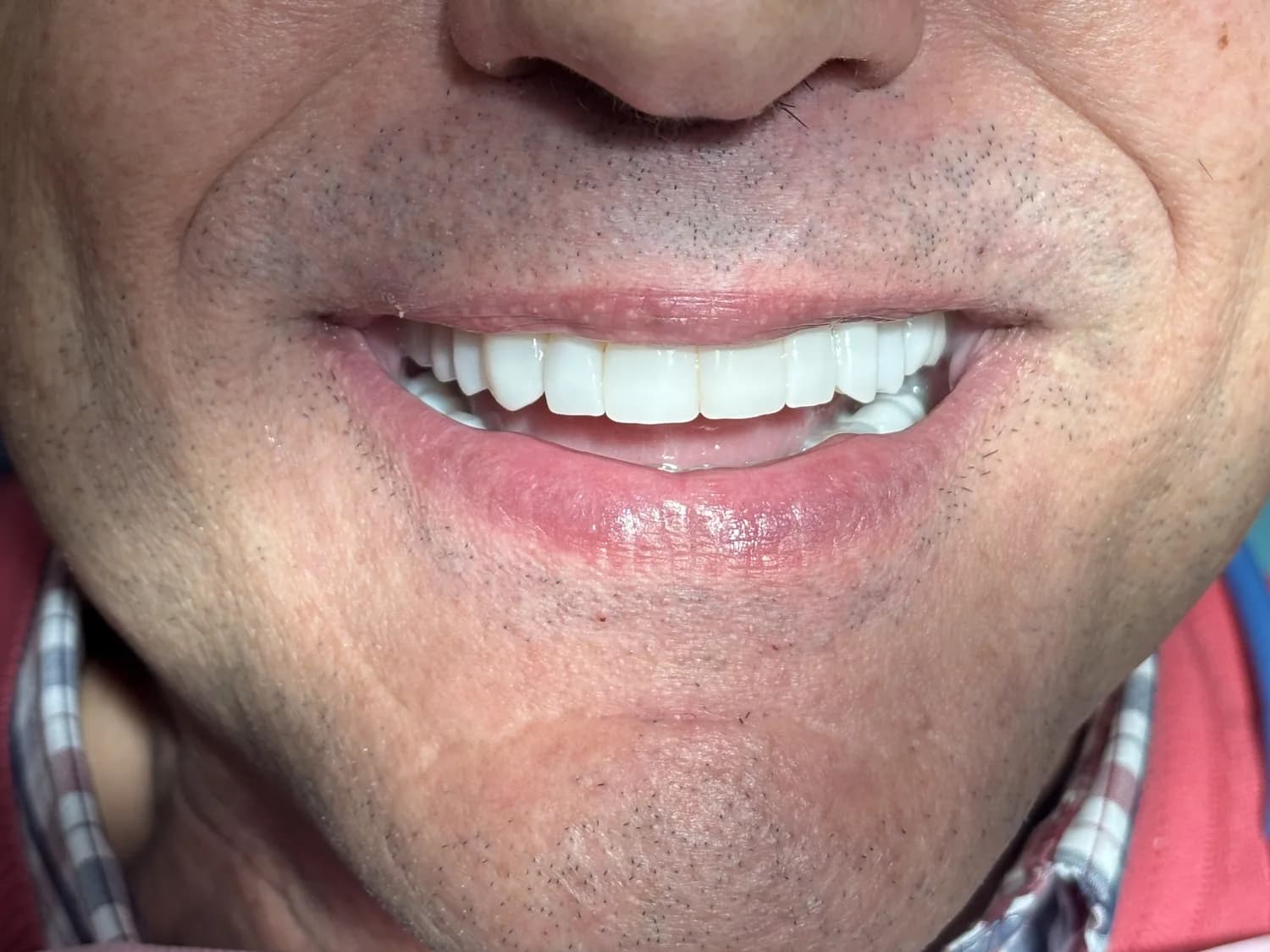 Después de las carillas de porcelana: sonrisa rehabilitada y natural — Clínica Carmen Fontes, Valencia