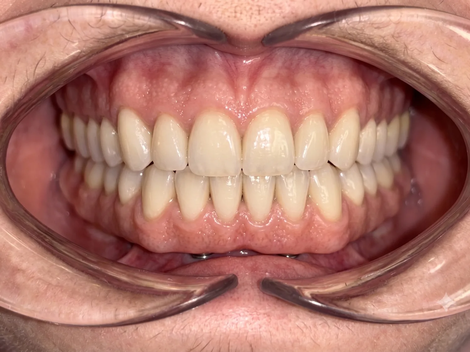 Después de la rehabilitación con implantes: dientes fijos y funcionales — Clínica Carmen Fontes, Valencia