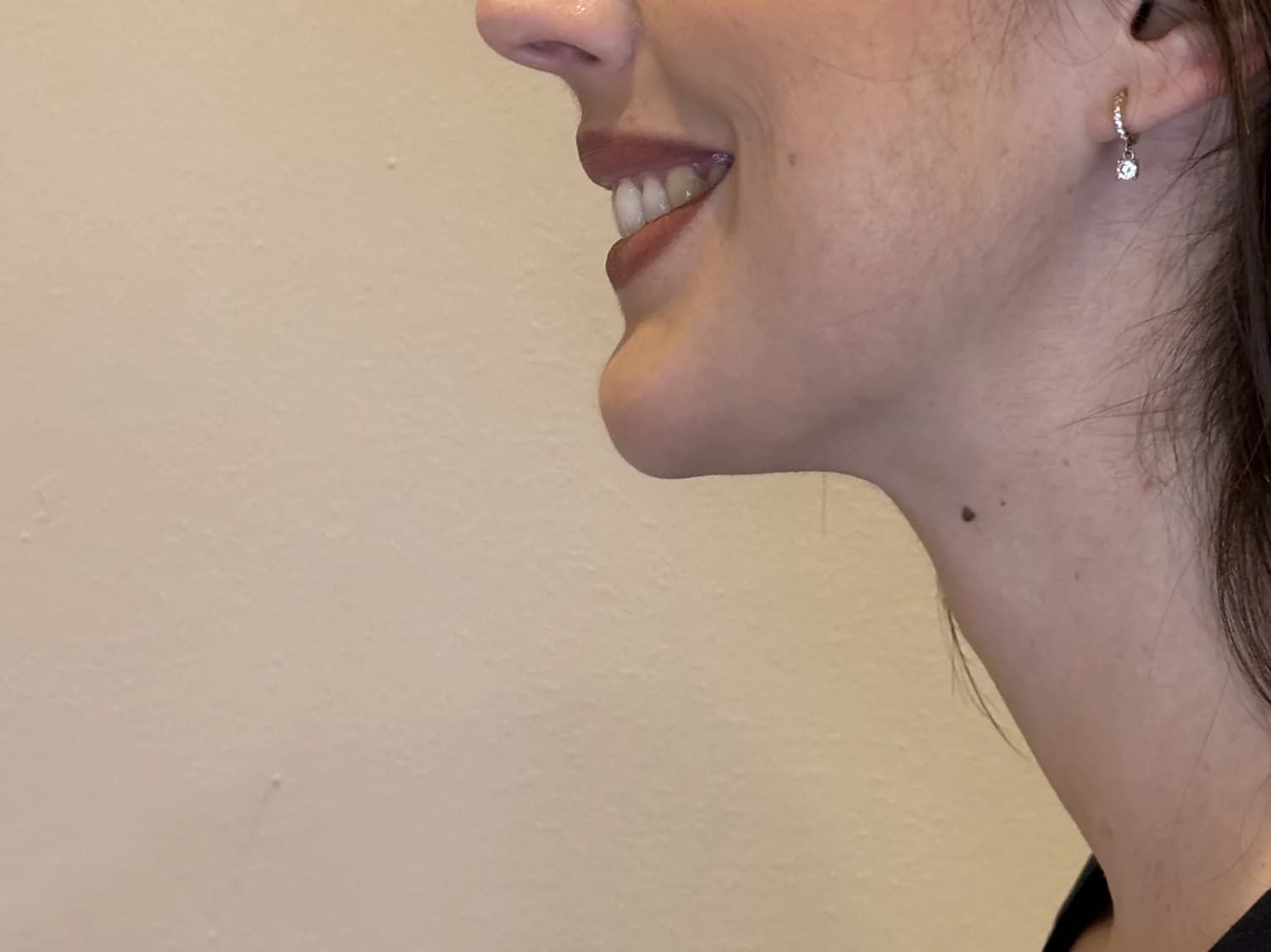 Después de la armonización facial: perfil más definido y armónico — Clínica Carmen Fontes, Valencia