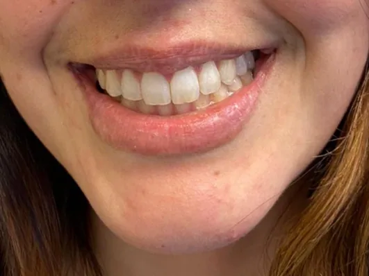 Después de la corrección de sonrisa gingival: sonrisa equilibrada — Clínica Carmen Fontes, Valencia