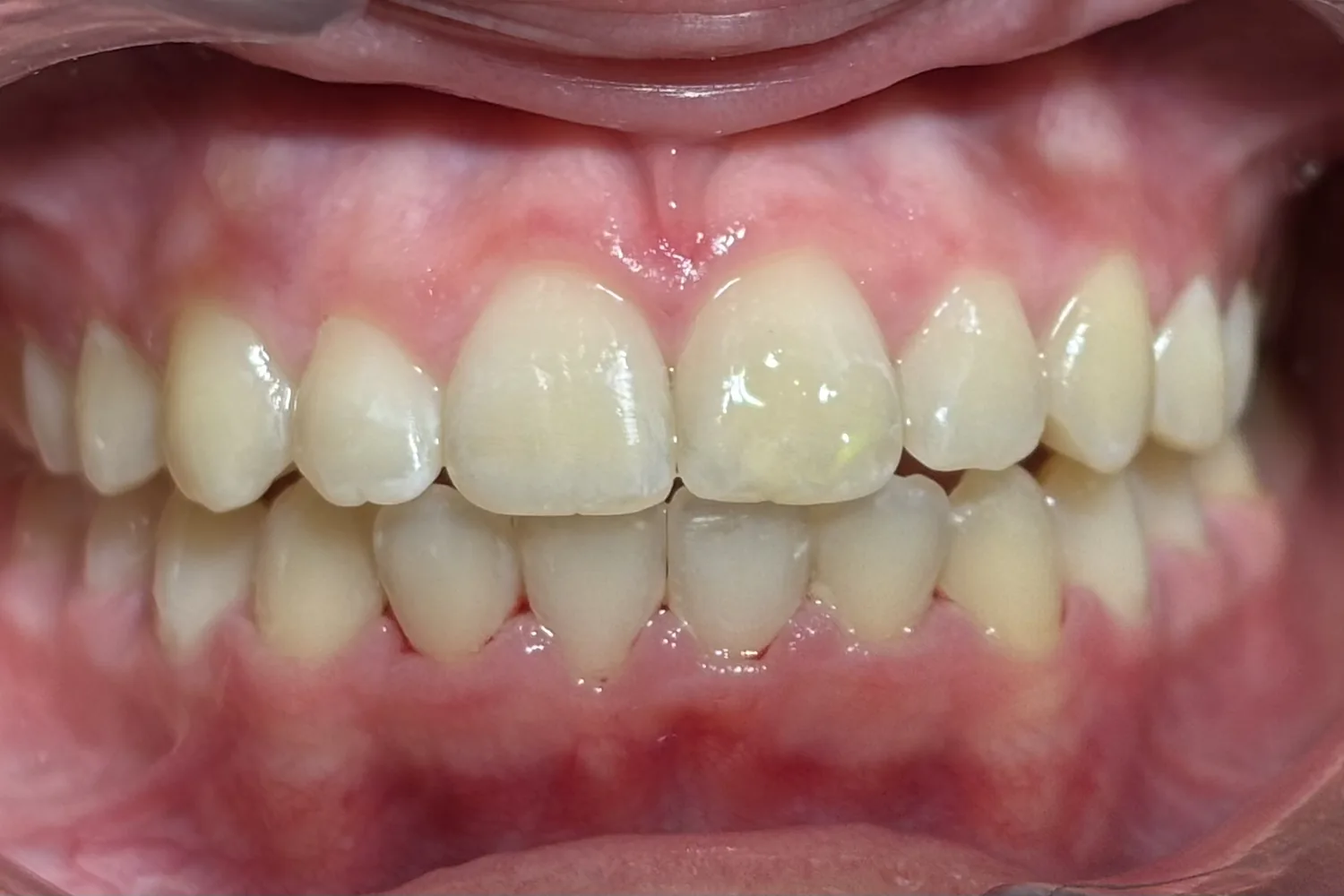 Después de la ortodoncia invisible: dientes alineados — Clínica Carmen Fontes, Valencia